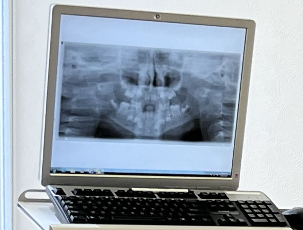 Early Treatment X-Ray